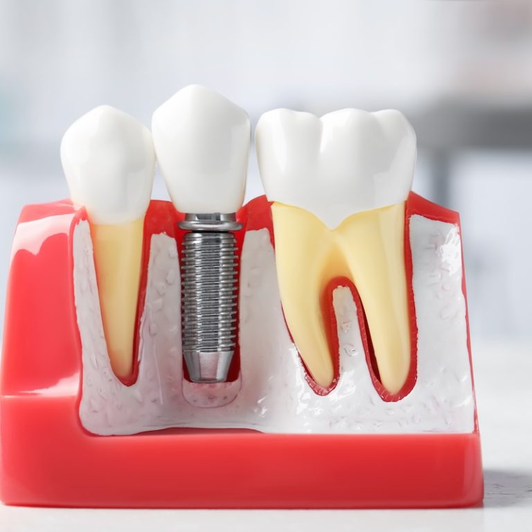 Educational model of gum with dental implant between teeth on white table indoors